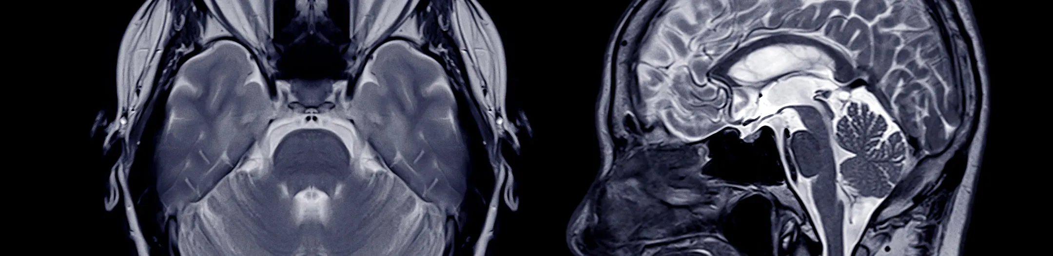 MRI brain scan comparison


